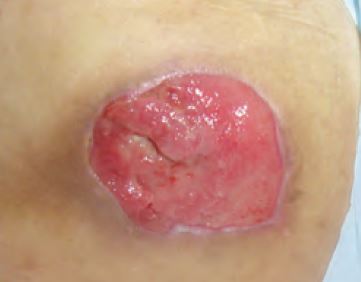 After use of Activon® Manuka honey