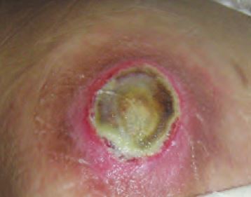 Before use of Activon Manuka honey