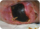 Necrotic Wound