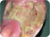 Necrotic Wound