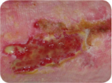 Necrotic Wound
