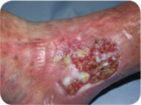 Necrotic Wound
